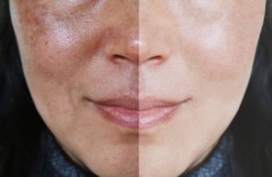 Rosto de mulher de pele clara, dividido em suas partes, uma mais escura com melasma e a outra, mais clara